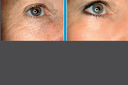 NaturaLase ER Photos